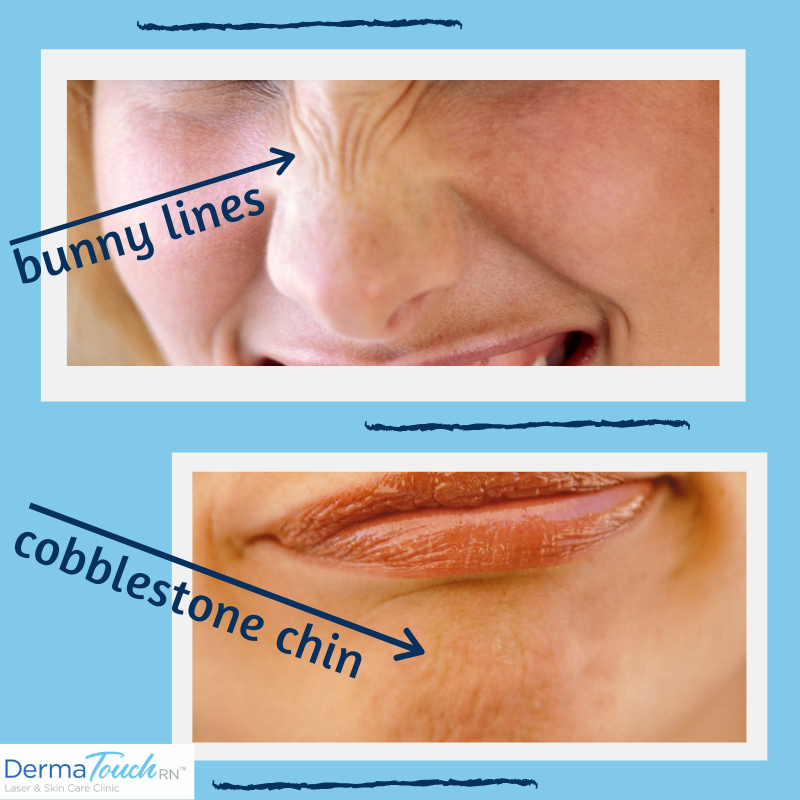 Units of Botox - Bunny Lines and Cobblestone Chin