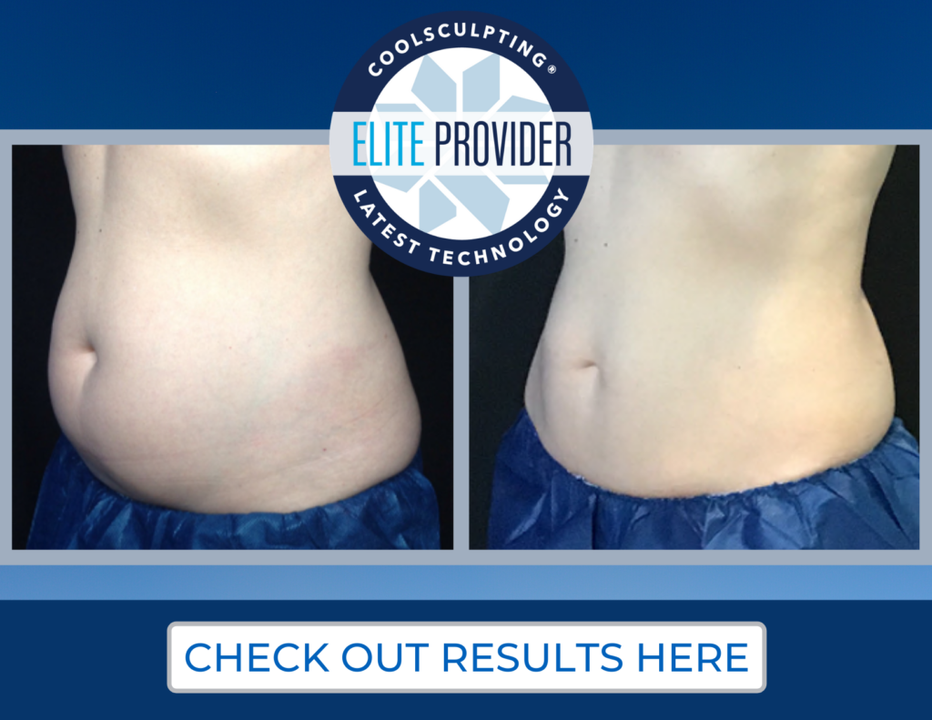 CoolSculpting Elite DermaTouch RN