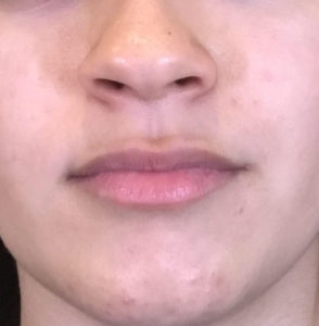 Lip Injections Before and After Pictures Houston, TX