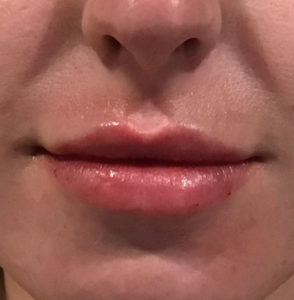Lip Injections Before and After Pictures Houston, TX
