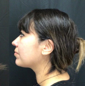 Kybella® Before and After Pictures in Houston & San Antonio, TX