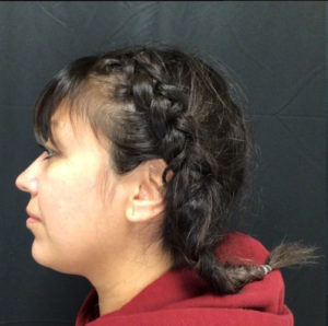 Kybella® Before and After Pictures in Houston & San Antonio, TX