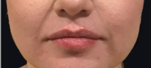 Lip Injections Before and After Pictures in Houston & San Antonio, TX