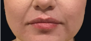 Dermal Fillers and Injectables Before and After Pictures Houston, TX