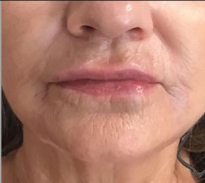 Dermal Fillers and Injectables Before and After Pictures Houston, TX