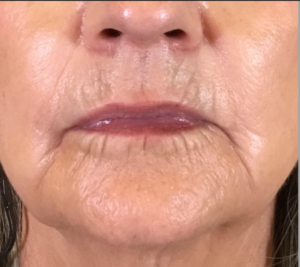 Dermal Fillers and Injectables Before and After Pictures Houston, TX