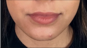 Dermal Fillers and Injectables Before and After Pictures Houston, TX