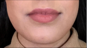 Dermal Fillers and Injectables Before and After Pictures Houston, TX