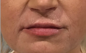 Dermal Fillers and Injectables Before and After Pictures Houston, TX