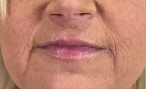 Dermal Fillers and Injectables Before and After Pictures Houston, TX