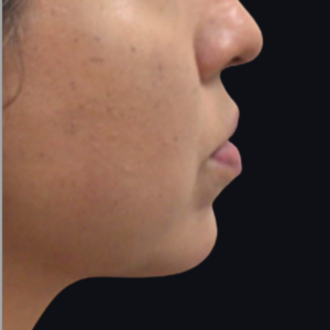 Dermal Fillers and Injectables Before and After Pictures Houston, TX