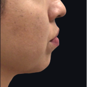 Dermal Fillers and Injectables Before and After Pictures Houston, TX