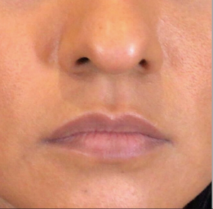 Dermal Fillers and Injectables Before and After Pictures Houston, TX