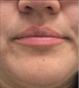 Dermal Fillers Before and After Pictures in Houston, TX