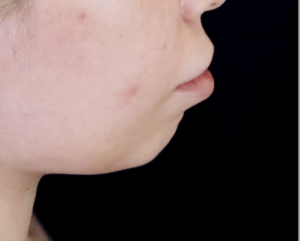 Dermal Fillers Before and After Pictures in Houston, TX