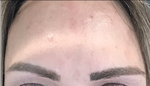 Botox® or Dysport® Before and After Pictures in Houston & San Antonio, TX