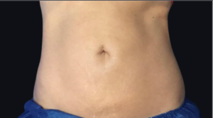 Coolsculpting® Before and After Pictures in Houston & San Antonio, TX