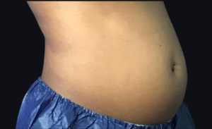 Coolsculpting® Before and After Pictures in Houston & San Antonio, TX