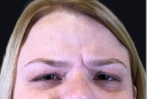 Botox® or Dysport® Before and After Pictures in Houston & San Antonio, TX