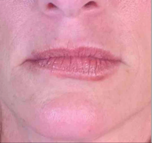 Lip Injections Before and After Pictures in Houston & San Antonio, TX