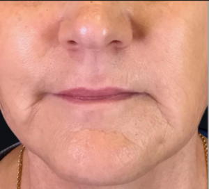 Dermal Fillers and Injectables Before and After Pictures Houston, TX