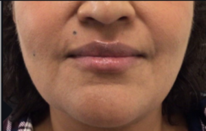 Dermal Fillers and Injectables Before and After Pictures Houston, TX