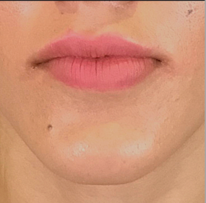 Dermal Fillers and Injectables Before and After Pictures Houston, TX