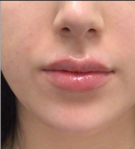 Dermal Fillers and Injectables Before and After Pictures Houston, TX