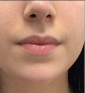 Dermal Fillers and Injectables Before and After Pictures Houston, TX