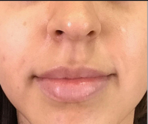 Dermal Fillers and Injectables Before and After Pictures Houston, TX