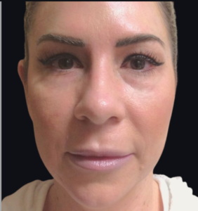 Dermal Fillers and Injectables Before and After Pictures Houston, TX