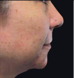 Dermal Fillers and Injectables Before and After Pictures Houston, TX