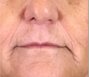 Dermal Fillers and Injectables Before and After Pictures Houston, TX