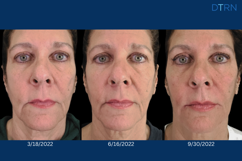 facial fillers before and after photos, juvederm filler