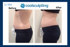 Does CoolSculpting Work? Blog