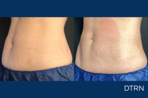 CoolSculpting for postpartum belly pooch