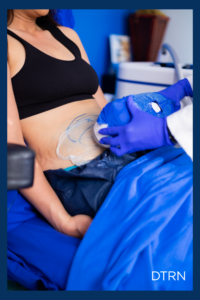Does CoolSculpting work on postpartum belly fat?