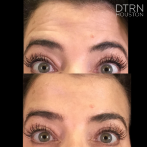 Botox before & after