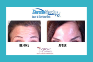 Botox® or Dysport® Before and After Pictures Houston, TX