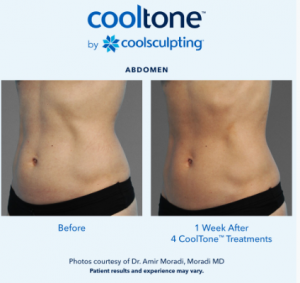 CoolTone DermaTouch RN Blog Houston, San Antonio