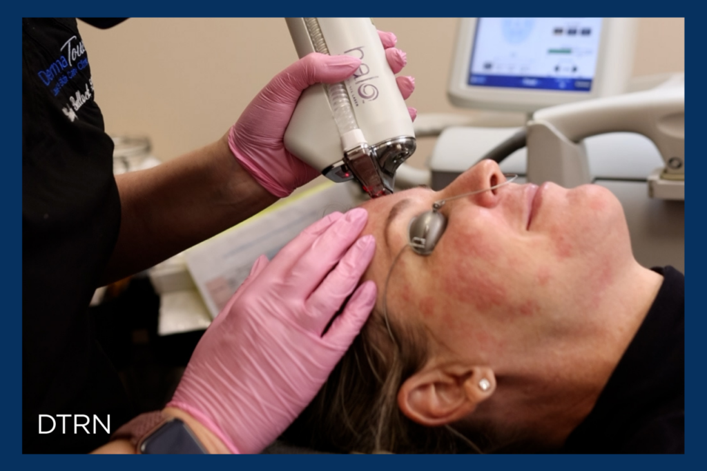 What Is Laser Skin Resurfacing?