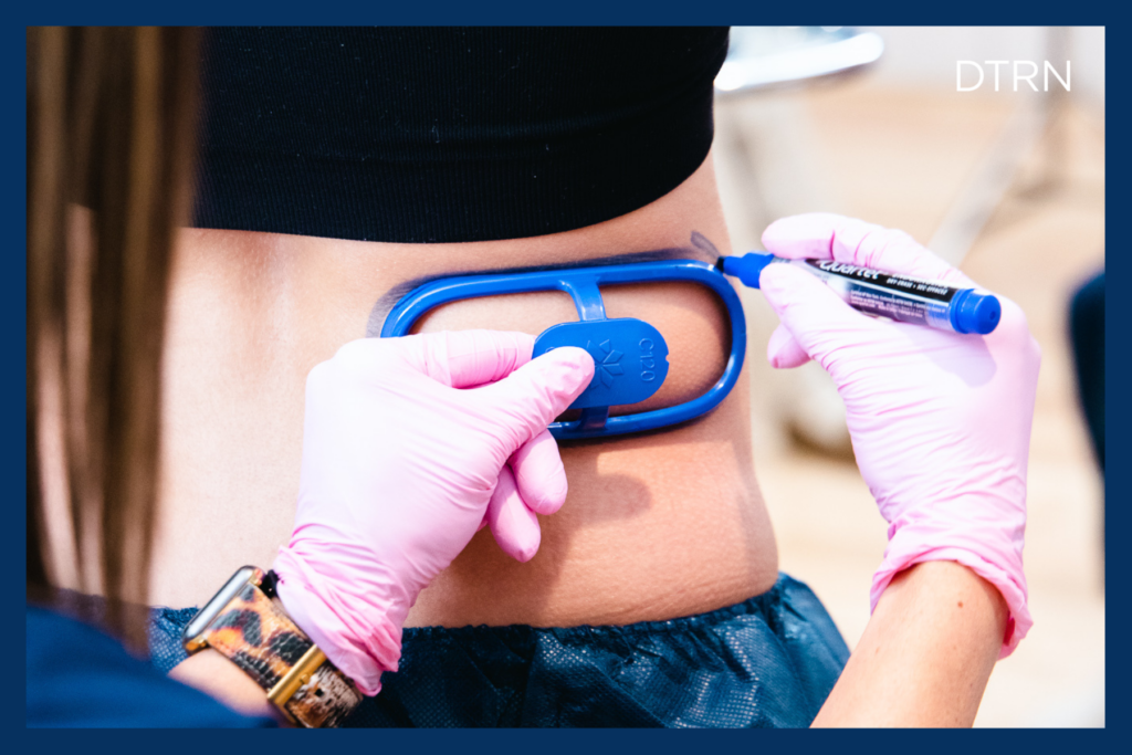CoolSculpting results are DermaTouch RN - San Antonio Houston blog CoolSculpting vs liposuction