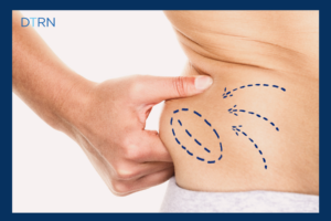 CoolSculpting Elit Blog DermaTouch RN
