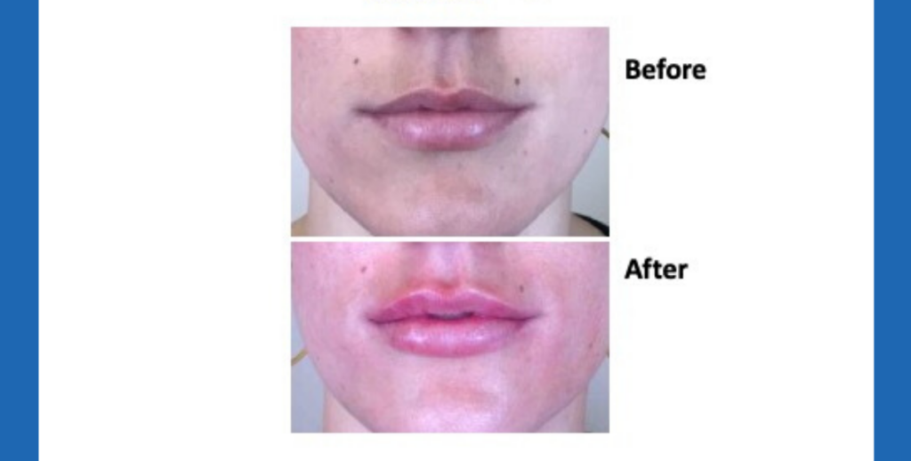 Tips to Get the Most out of Your Houston Juvederm lip filler Appointment