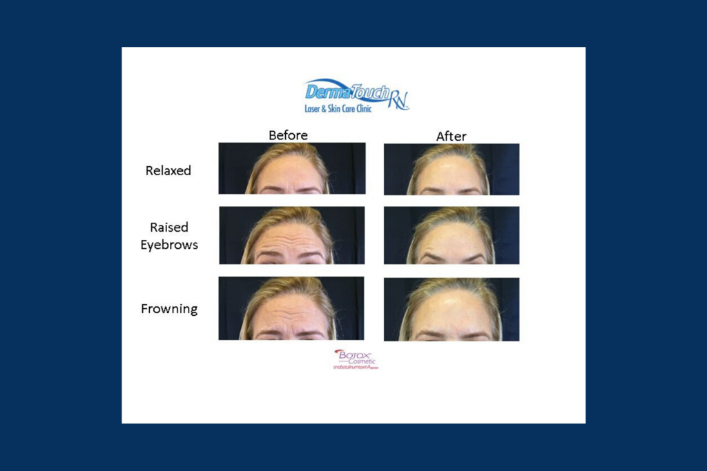 Botox Before & After