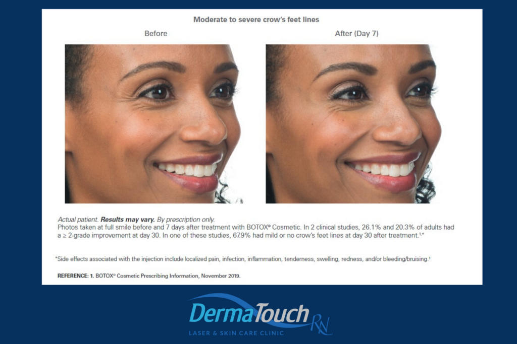 Botox Crow's Feet Before & After DermaTouch RN
