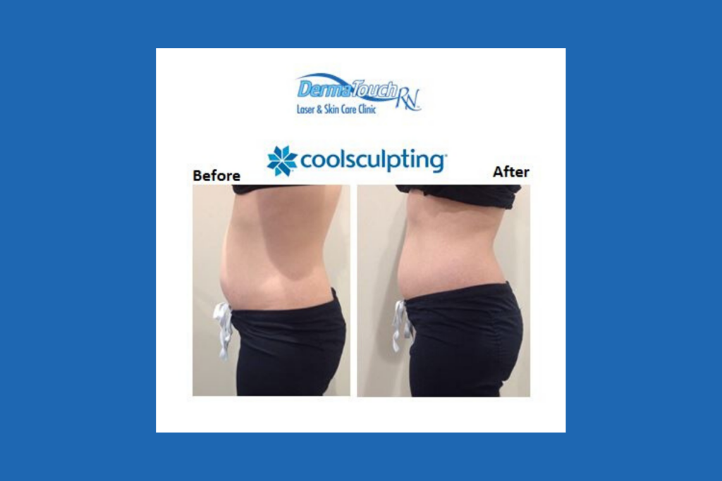 Houston DermaTouch RN CoolSculpting