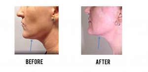 Kybella® Before and After Pictures Houston, TX
