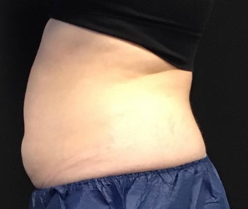 Coolsculpting® ELITE Case 48 After Image