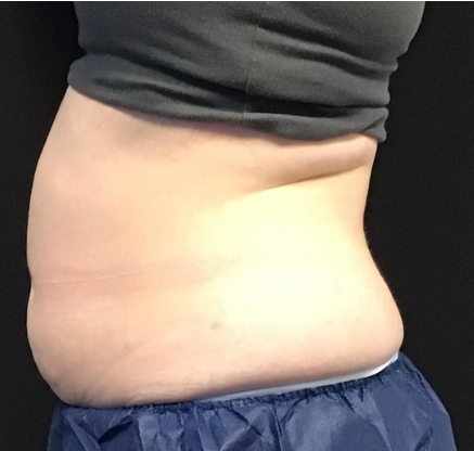 Coolsculpting® ELITE Case 48 Before Image